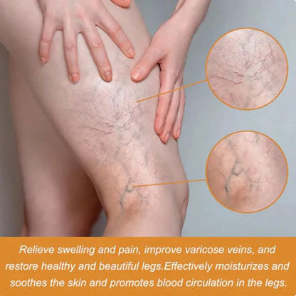 Turmeric Varicose Vein Relief Spray (BUY 1 GET 2 FREE 😍)